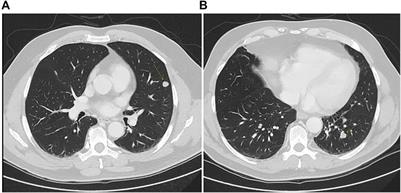 Case Report: The Added Value of Liquid Biopsy in Advanced Colorectal Cancer From Clinical Case Experiences